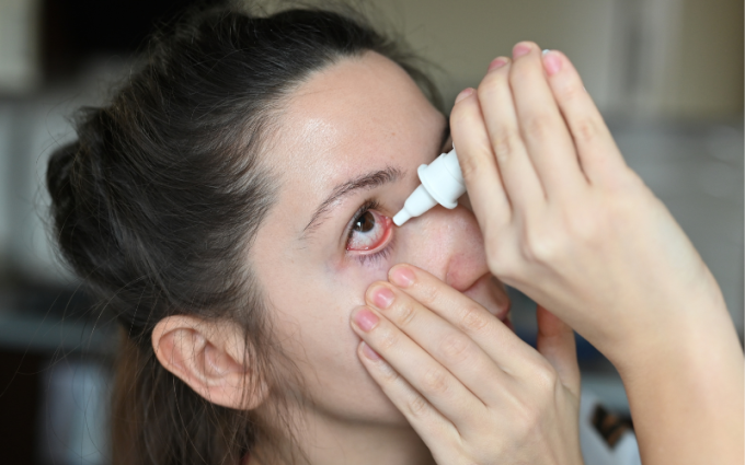 Jak leczyć przekrwione oczy?
