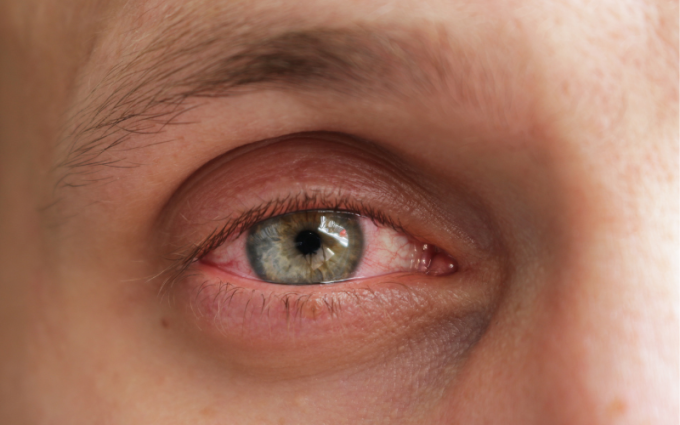 Jakie są przyczyny przekrwionych oczu?