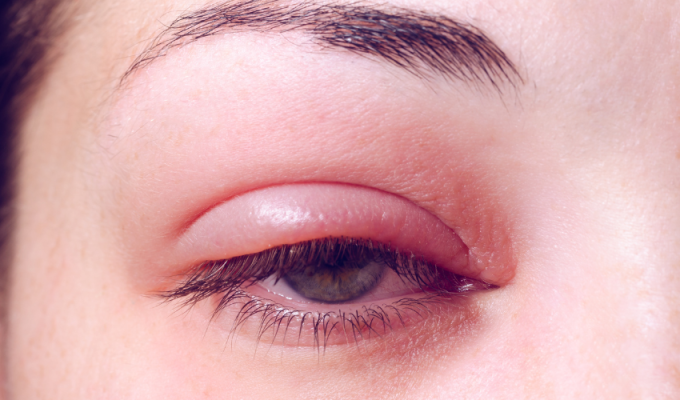 Jęczmień oka - leczenie